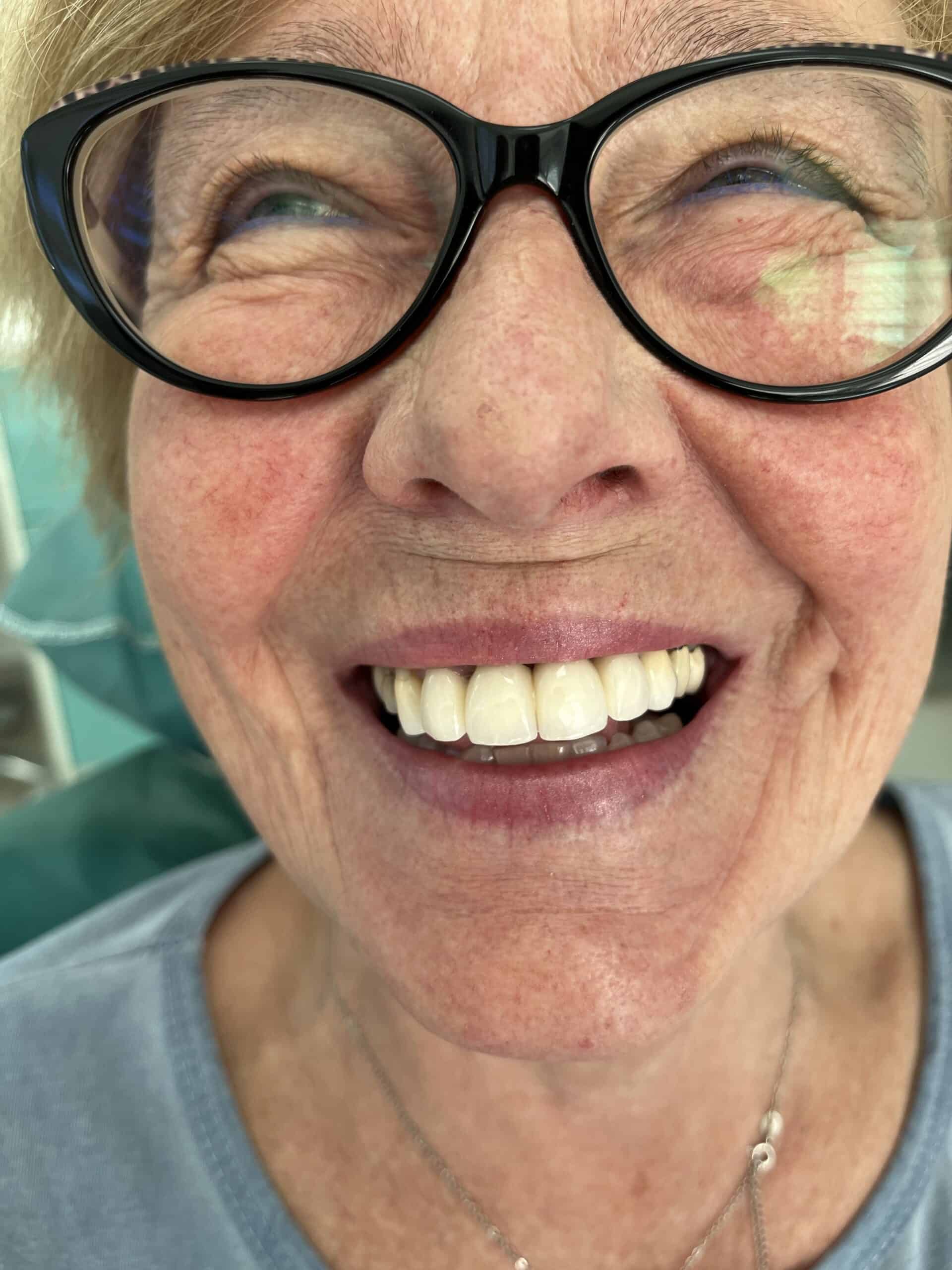 amazing results before and after dental crowns in Albania