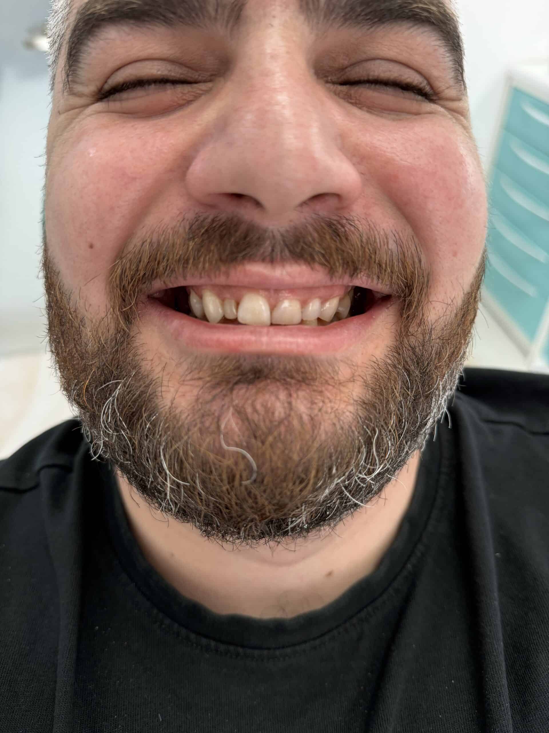 Smile with dental treatment, happy man showing teeth, close-up.