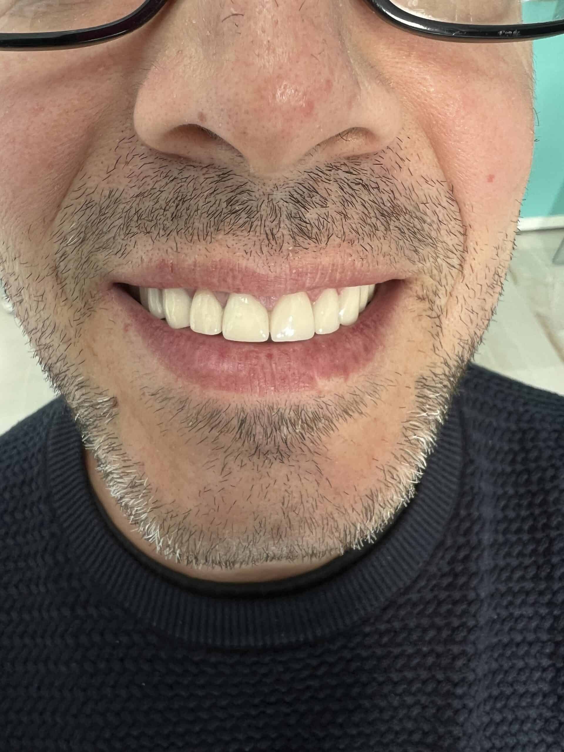 patient results before and after dental crowns in Albania