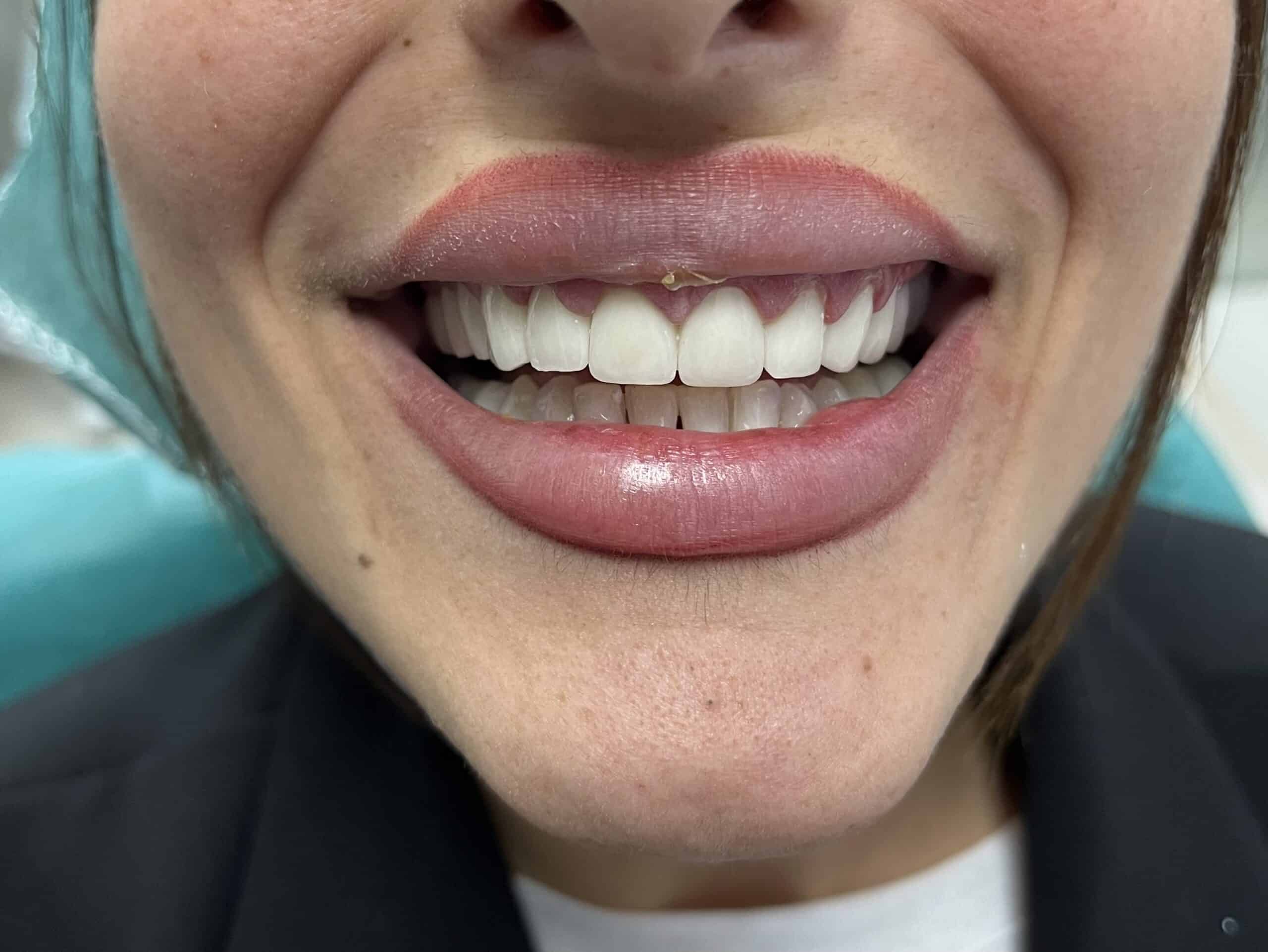 Chipped front tooth visible in a dental patient’s smile, awaiting cosmetic dental care.