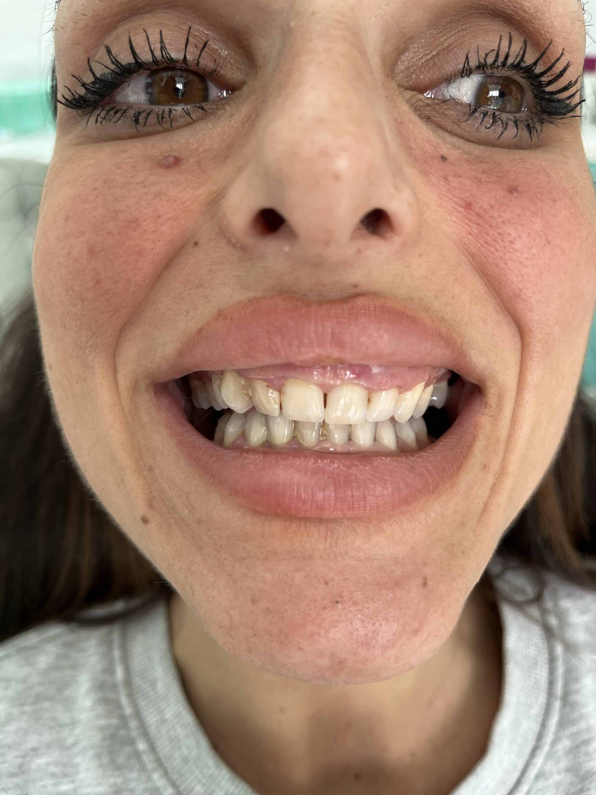 Close-up of a woman with misaligned and stained teeth, smiling in a dental clinic setting.