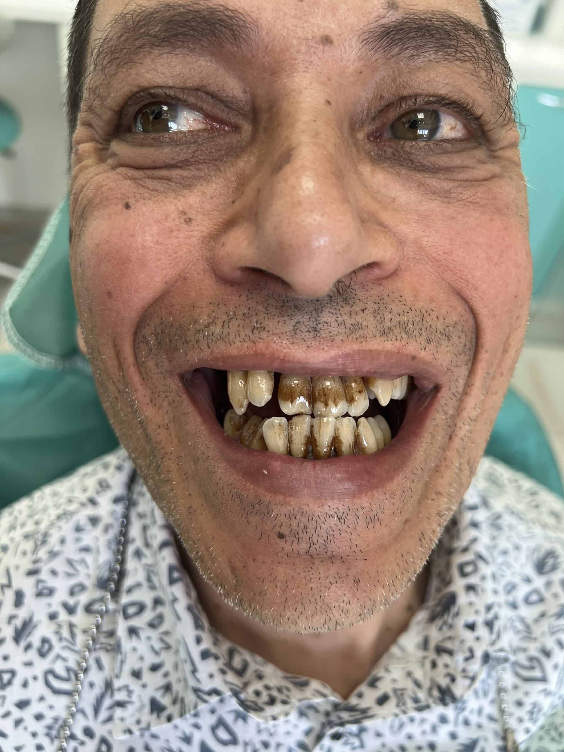 Patient with decayed, stained teeth before dental treatment.
