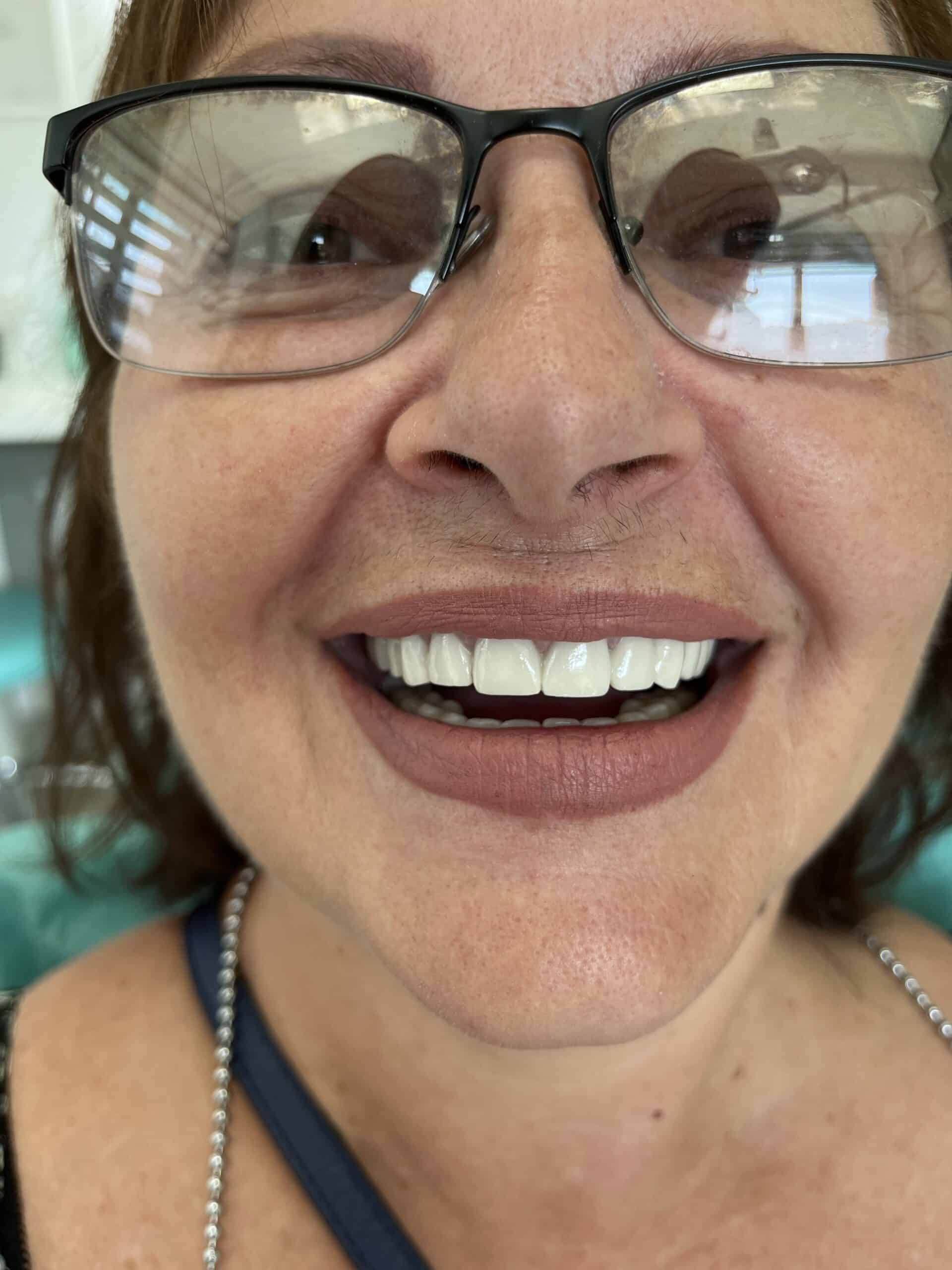 Smiling woman with glasses showing her clean, white teeth.