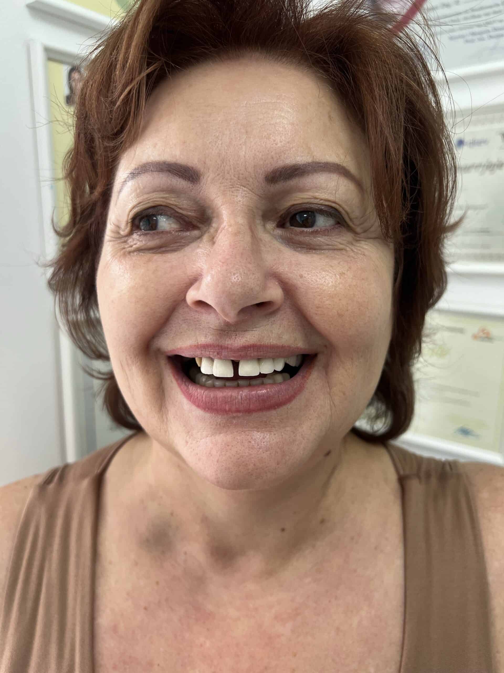 Dental patient with missing and damaged teeth smiling in a clinic.