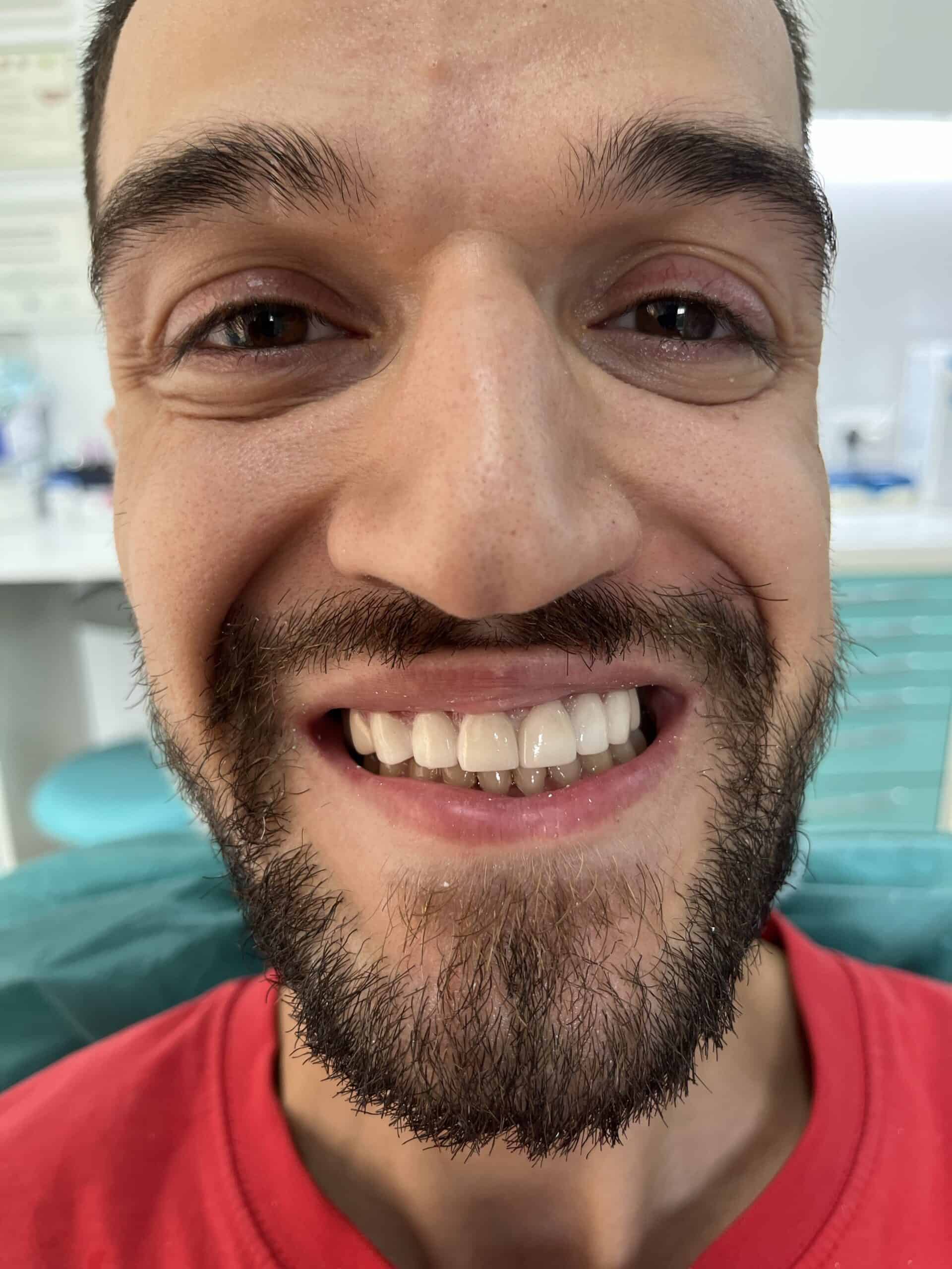 patient results before and after dental crowns in Albania