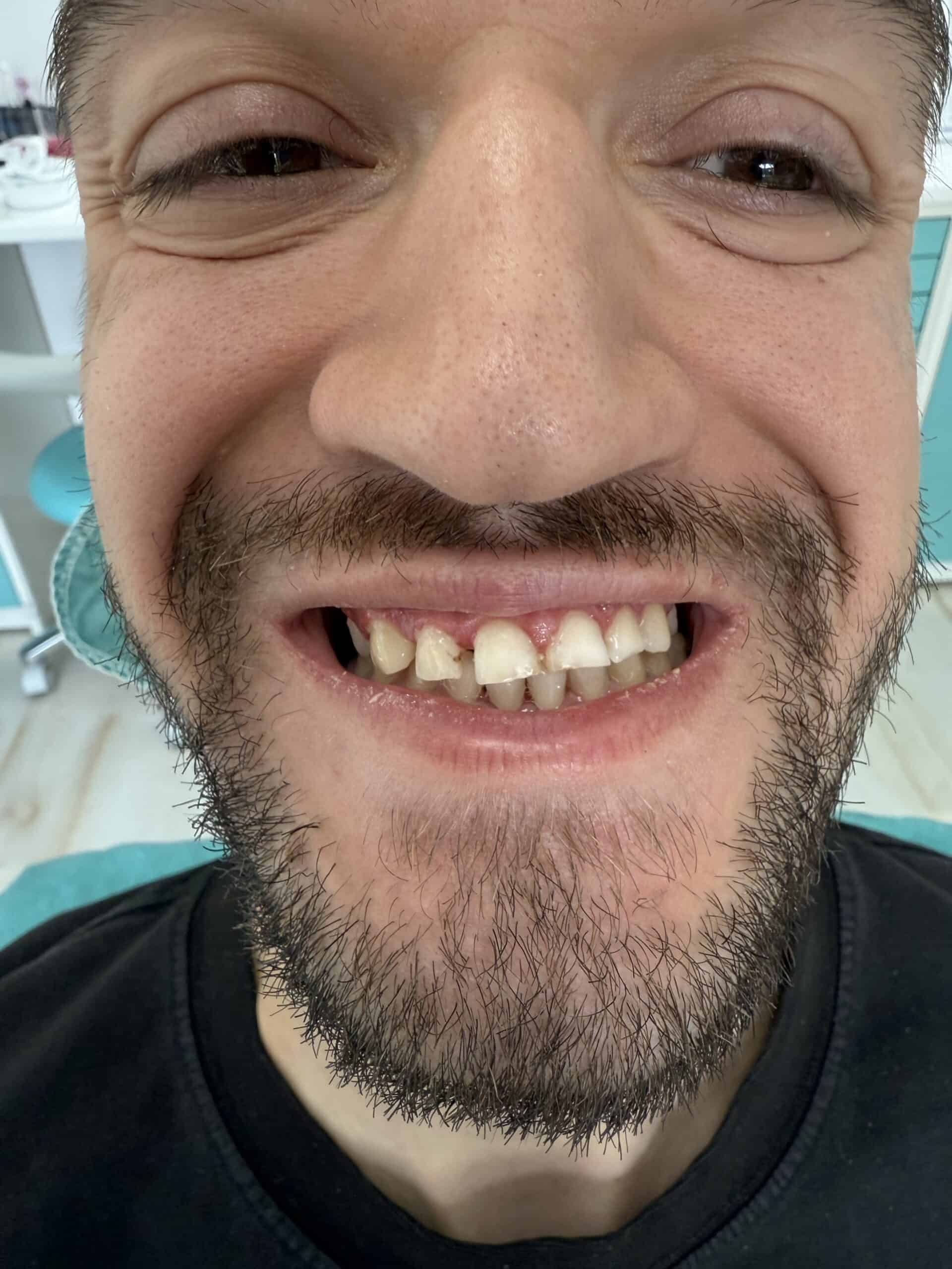 patient results before and after dental crowns in Albania