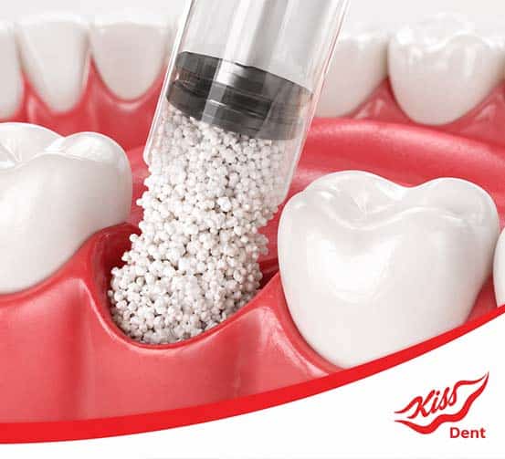 mbjellje kockash për implante dentare me pak kockë