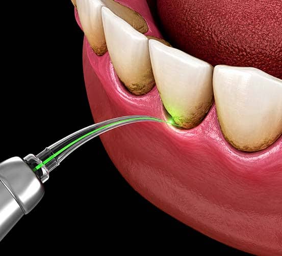 Pulizia dentale laser per la rimozione della placca e il miglioramento della salute orale.