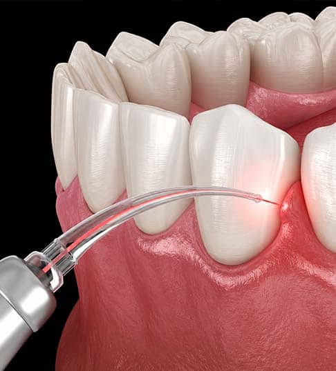 terapia laser per la malattia gengivale