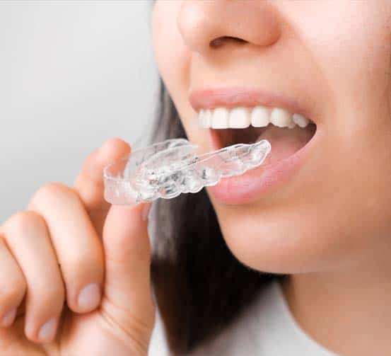 nuvola invisible aligners in Albania