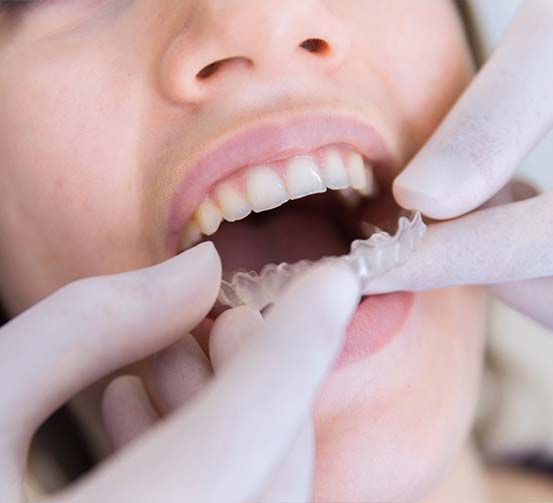 post orthodontic treatment retainers in Tirana