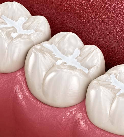 preventive dental sealants in Albania