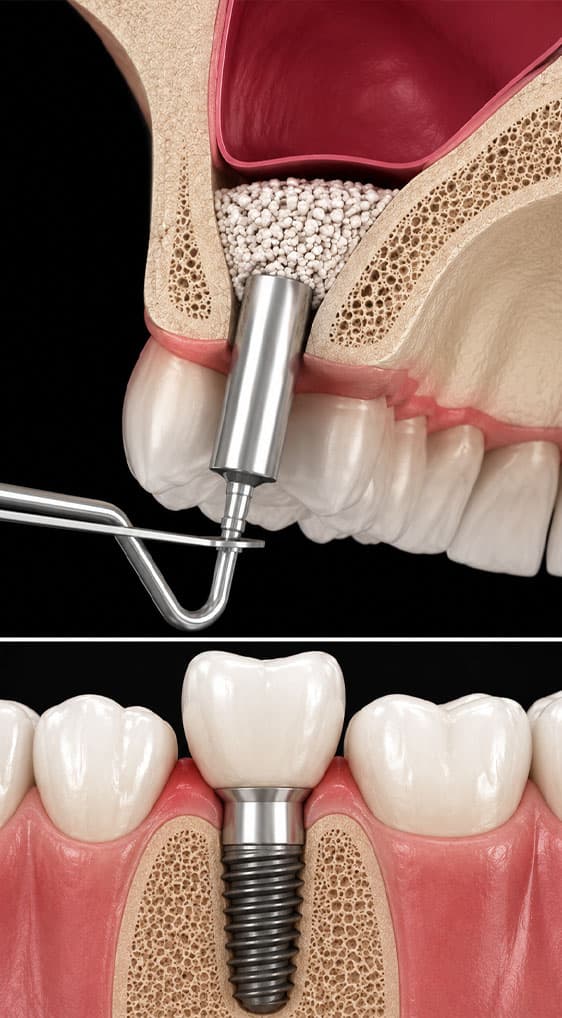 Procesi i implantit dentar duke treguar shpimin në kockën e nofullës për zëvendësimin e dhëmbit.