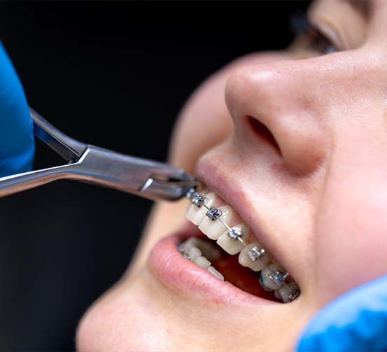 braces metal tradicional në tiranë