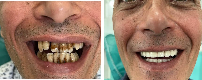 Step-by-step dental implant process showing tooth extraction to crown placement.