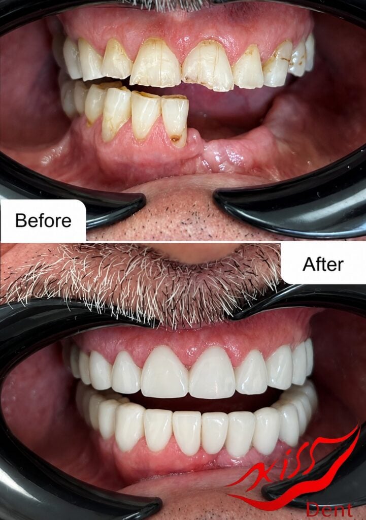 Before and after dental restoration showing improved teeth alignment and whitening.